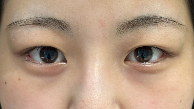 手術前の状態 その1