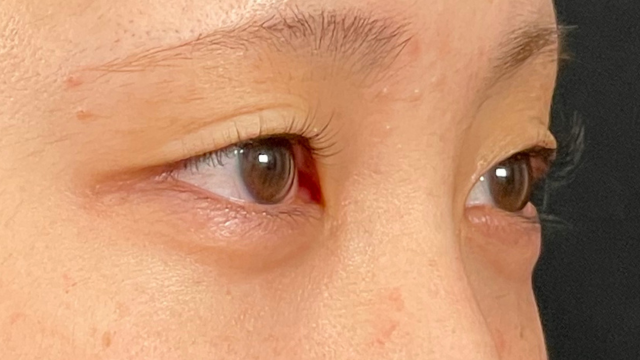 手术前的状态 其一