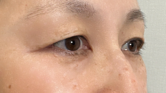 手术前的状态 其一