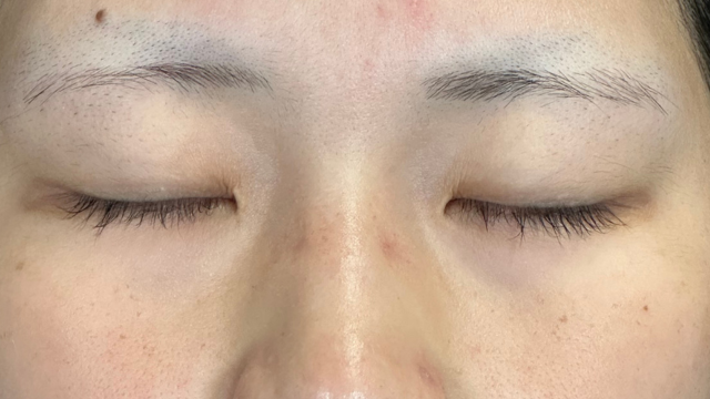 手術前の状態 その1