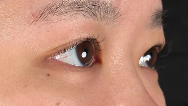 手术前的状态 其一