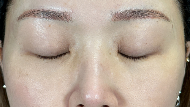 手術前の状態 その1