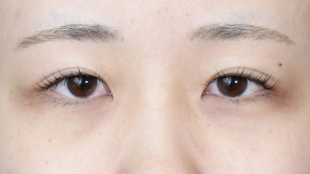 手術前の状態 その1