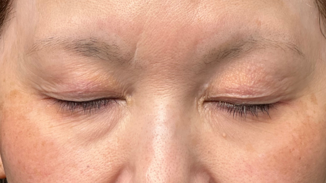 手术前的状态 其一