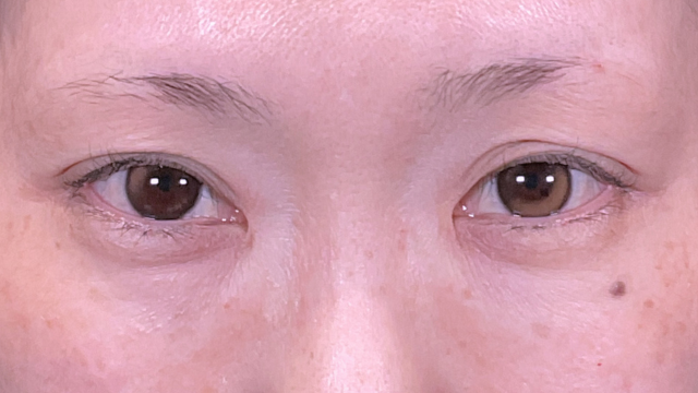 手术前的状态 其一