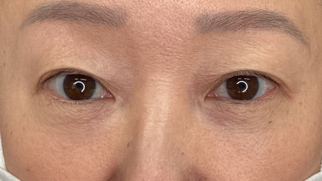 手術前の状態 その1