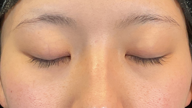 手术前的状态 其一