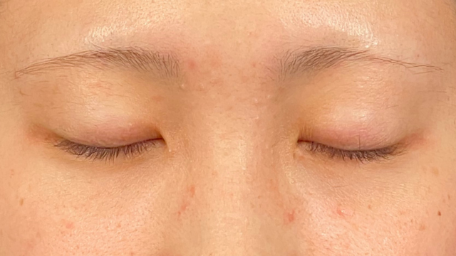 手术前的状态 其一