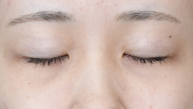 手術前の状態 その1