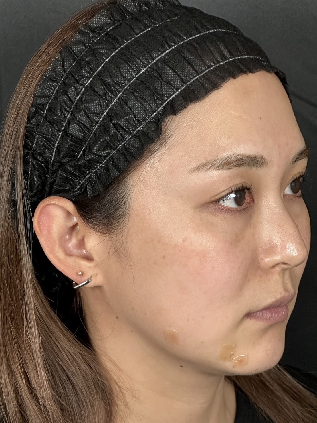 手术前的状态 其一