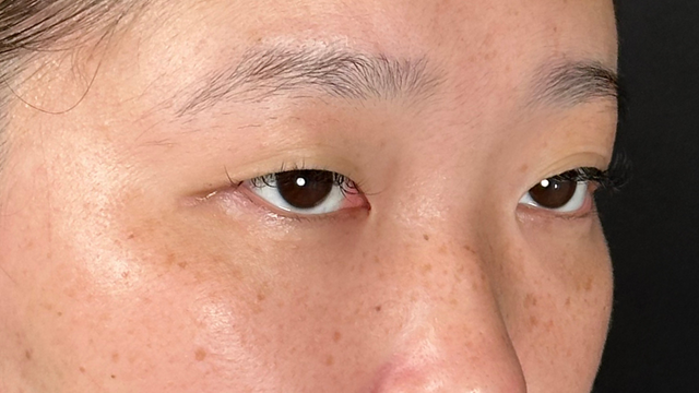 手术前的状态 其一