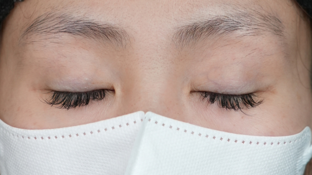 手術前の状態 その1