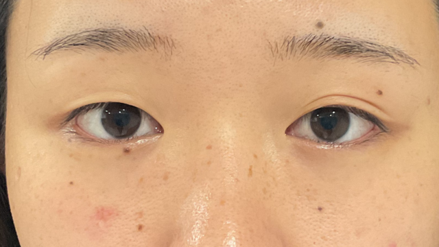 手术前的状态 其一