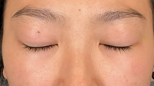 手术前的状态 其一