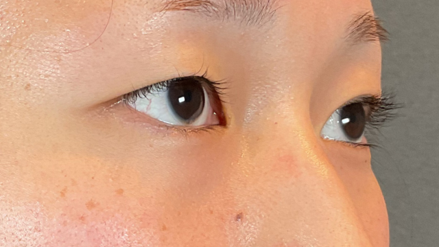 手術前の状態 その1