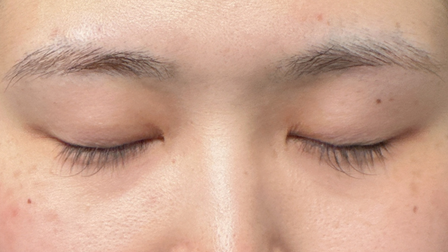 手术前的状态 其一