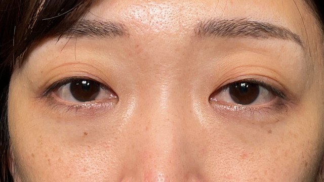 手術前の状態 その1