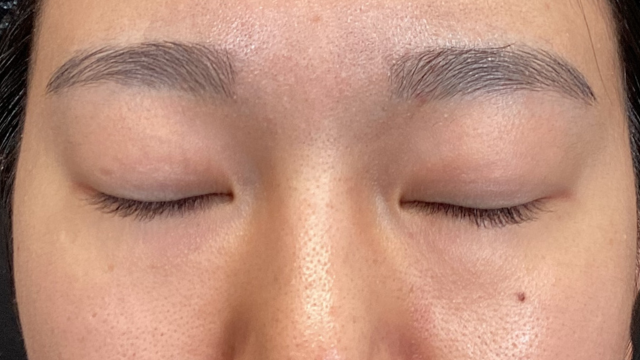 手術前の状態 その1