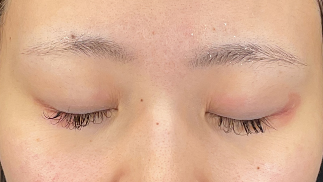 手术前的状态 其一