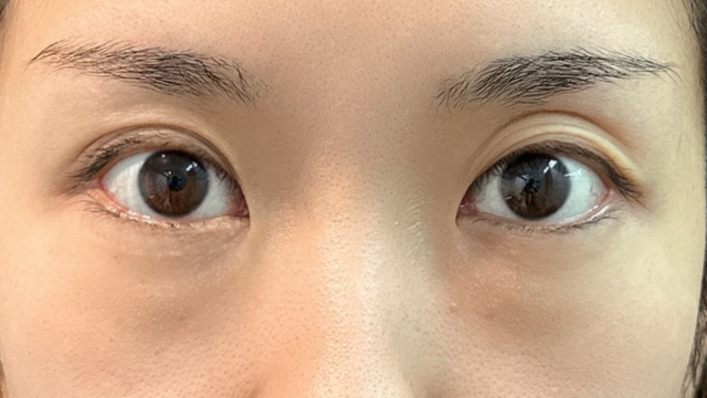 手术前的状态 其一