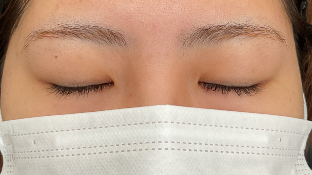 手術前の状態 その1