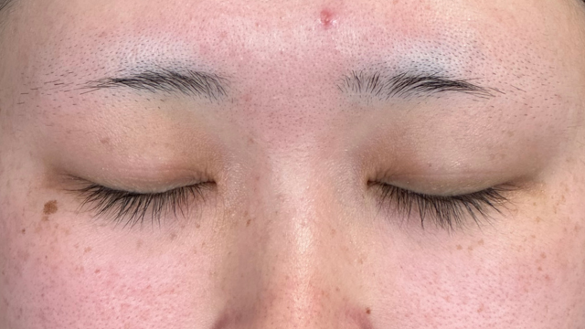 手術前の状態 その1