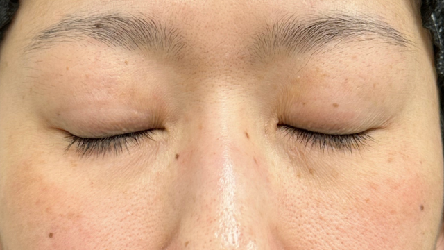 手术前的状态 其一