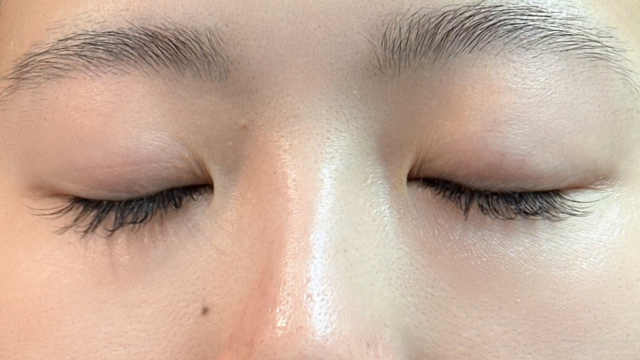 手術前の状態 その1