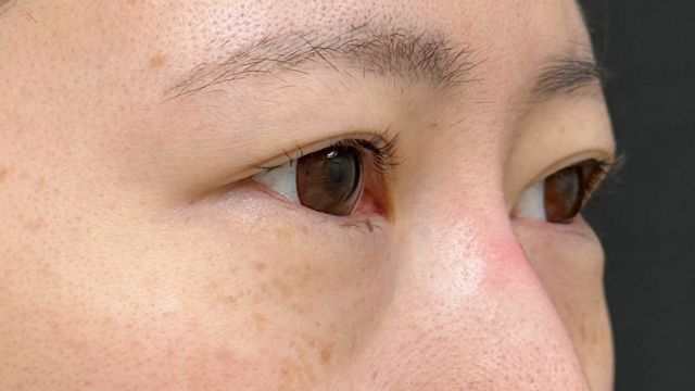 手术前的状态 其一