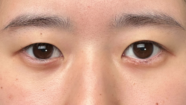 手术前的状态 其一