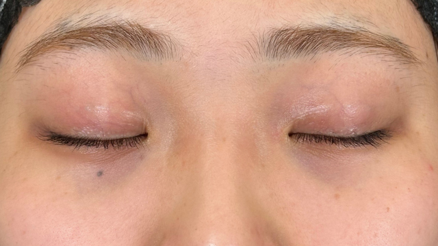 Postoperative Condition Part 1