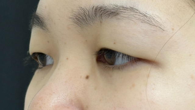 手術前の状態 その1