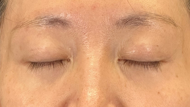 手術前の状態 その1