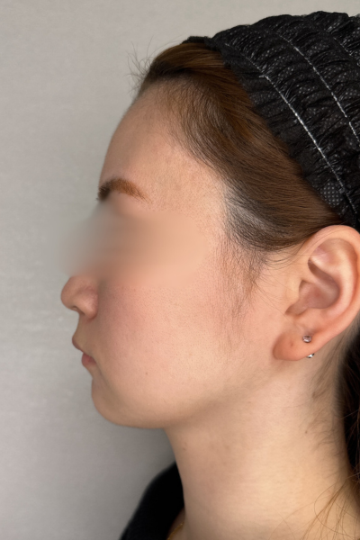 手術前の状態 その1