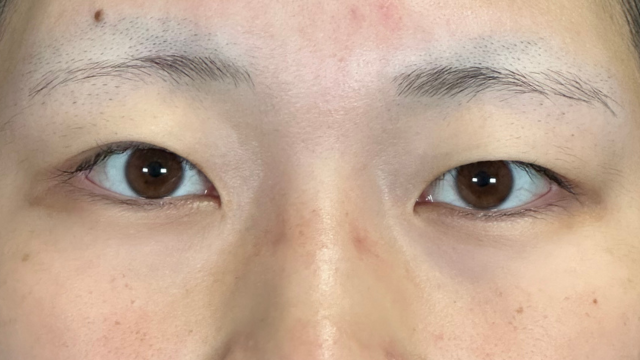 手術前の状態 その1