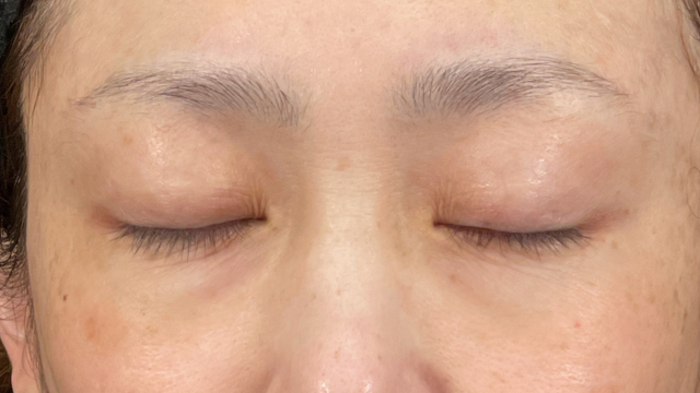 手術前の状態 その1