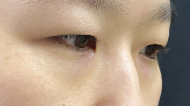 手术前的状态 其一