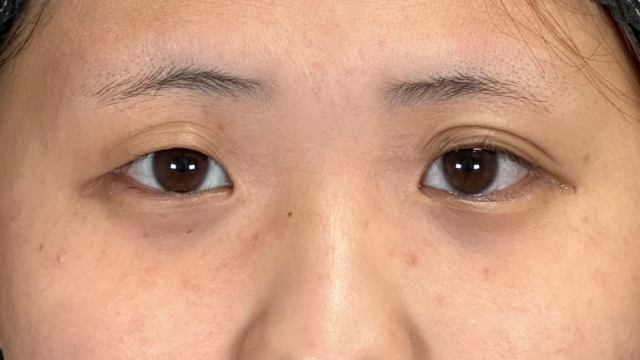 手术前的状态 其一