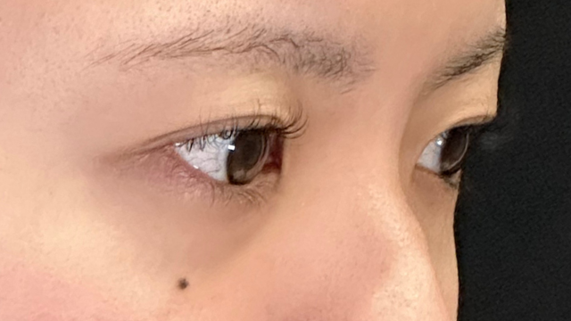 手術前の状態 その1