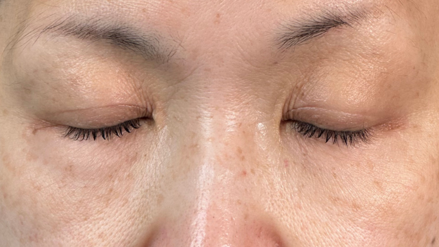 手術前の状態 その1