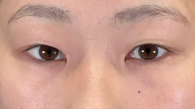 手術前の状態 その1