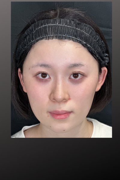 手術前の状態 その1