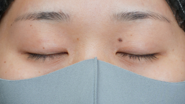 手術前の状態 その1