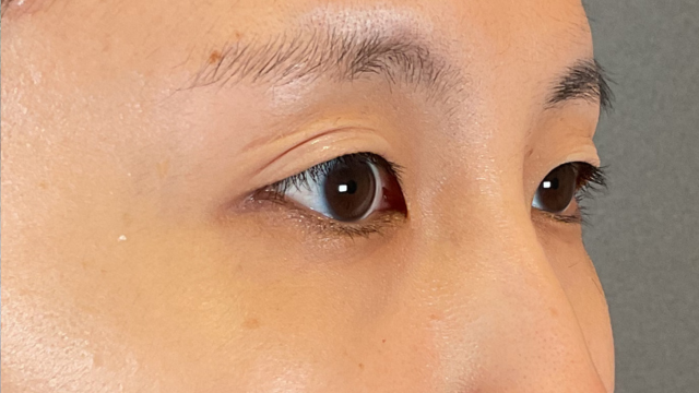 手術前の状態 その1