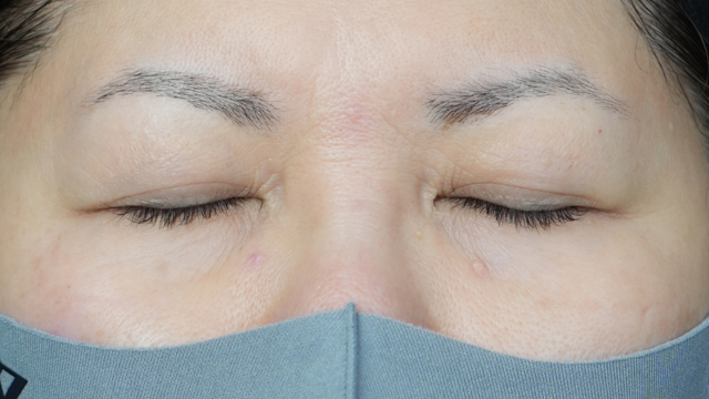 手術前の状態 その1