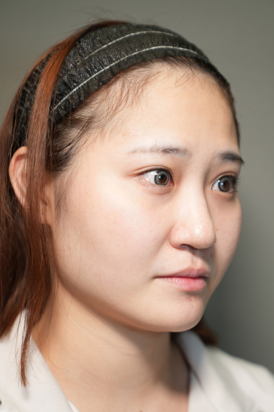 手术前的状态 其一