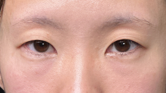 手术前的状态 其一