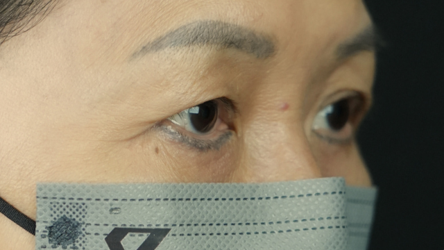 手术前的状态 其一