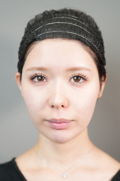 手術前の状態 その1