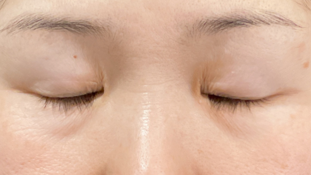 手术前的状态 其一